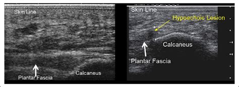 21+ Plantar Fascia Ultrasound - HankSangat