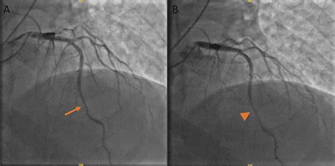 Myocardial Bridging of Mid-left Anterior Descending Artery (LAD ...