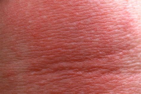 5 Things You Can Do to Control Atopic Dermatitis - DK Glowy