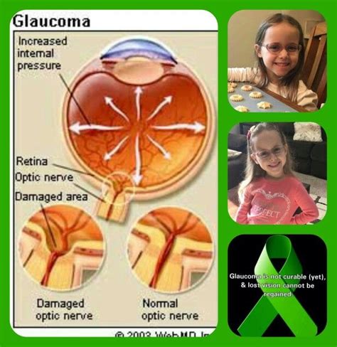 Congenital glaucoma awareness! Alternative Treatments, Osteoporosis, Nugget