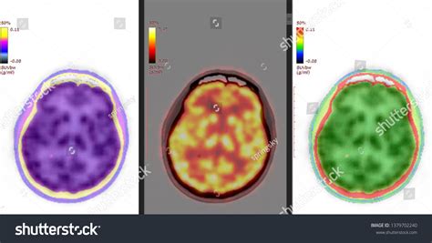 Pet Ct Scan Human Brain Axial Stock Photo 1379702240 | Shutterstock