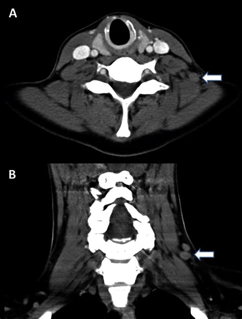 A soft tissue CT scan of the neck indicated lymphadenopathy A) Axial... | Download Scientific ...