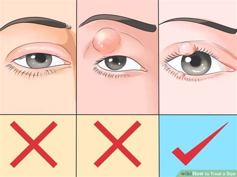 How to Treat a Stye | How to do it