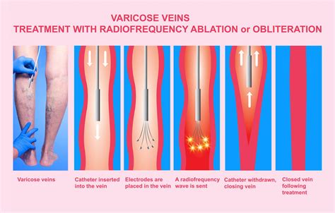 Varicose Veins - Glacier Surgical Associates