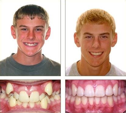 Before And After Braces Picture | Before And After Braces