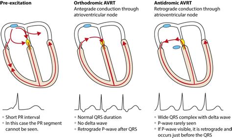 Figure 3. Antidromic and orthdromic AVRT. – ECG learning