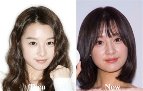 Kim Ji Won Plastic Surgery Before and After Photos - Latest Plastic ...