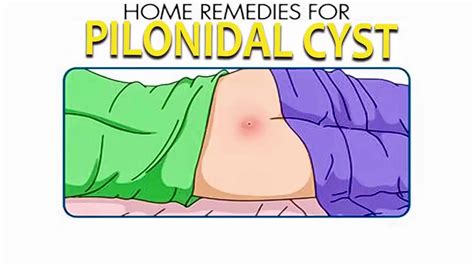 Pilonidal Cyst Home Treatment - Homemade Ftempo