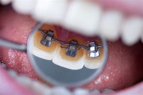 Lingual Braces Brooklyn NY - Halabi Orthodontics