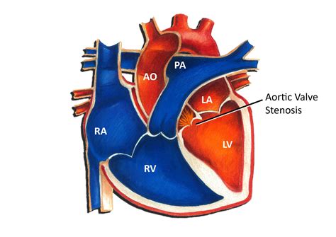 Aortic Valve Stenosis - Pediatric Heart Specialists