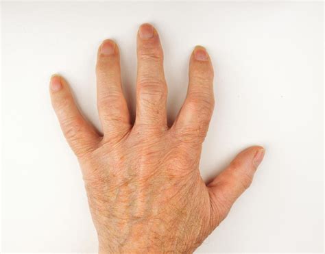 Gérer L'Arthrite Dans Les Mains : Conseils Et Solutions Efficaces