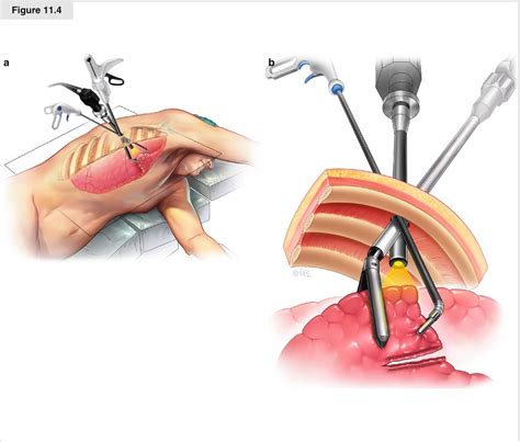 VATS Wedge Resection | Thoracic Key