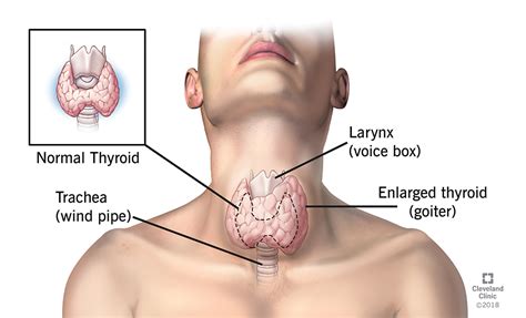 Goiter: Causes, Risk Factors, Symptoms, Diagnosis & Treatment