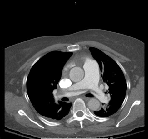 04_pe-saddle - Differential Diagnosis of