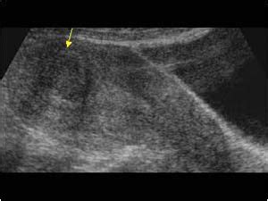 WK 3 L 2 Submucosal fibroid with a hypoechoic mass longitudinal | Fibroids, Ultrasound ...