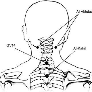 Wet-cupping treatment points | Download Scientific Diagram