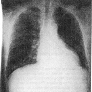 Figu re 5. The echocardiogram revealed a picture of global hypokinesia... | Download Scientific ...