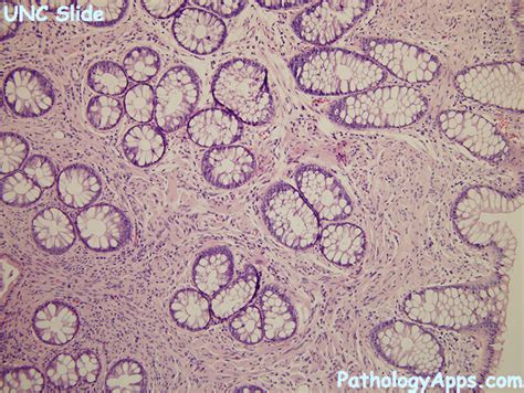 schwann cell hamartoma small intestine, large intestine, intestine histology