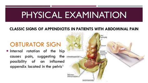 Acute Appendicitis