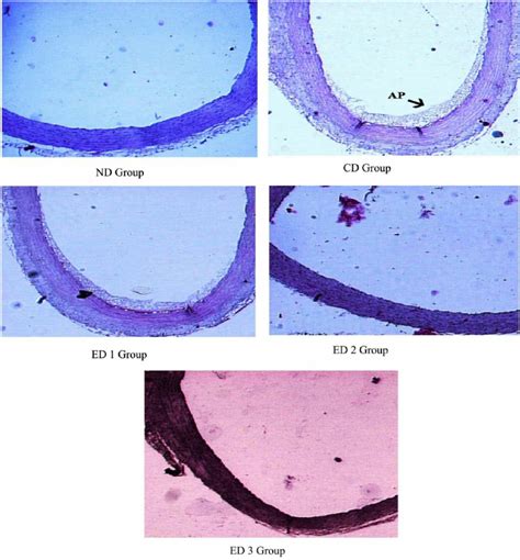 Histology of aorta. AP, atheromatous plaque; ND, normal diet fed; CD,... | Download Scientific ...