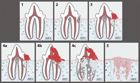 External Tooth Resorption in Cats, Part 2: Therapeutic Approaches ...