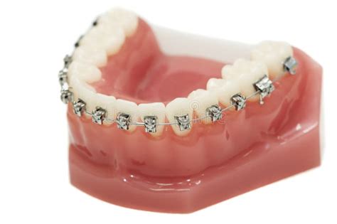 Lower Dental Jaw Bracket Braces Stock Image - Image of orthodontist, stomatology: 20139827