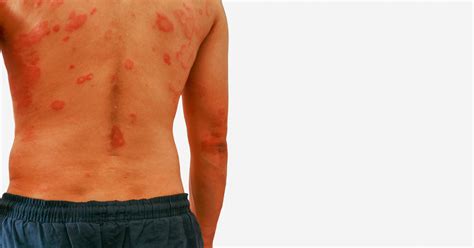 Autoimmune and blistering diseases: What you need to know about bullous pemphigoid, pemphigus ...