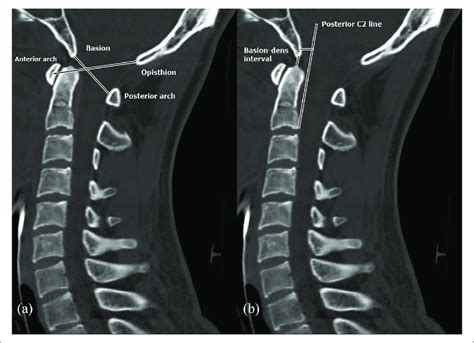 Spect Ct Scan Cervical Spine Ct Scan Machine | Images and Photos finder