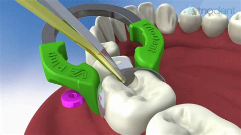 Triodent V3 Sectional Matrix System Animation (Voice-Over) - YouTube