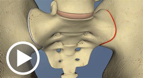 Diagnosing Sacroiliac Joint Dysfunction | MedBridge