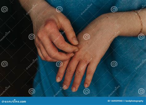 Dermatology Problem, Eczema Stock Photo - Image of medical, itch: 144939940