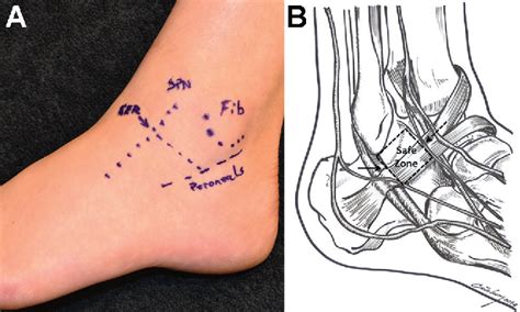 Inferior extensor retinaculum | Semantic Scholar