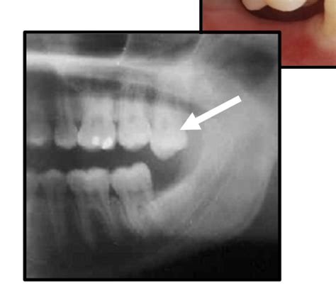 what happens after tooth extraction Flashcards | Quizlet