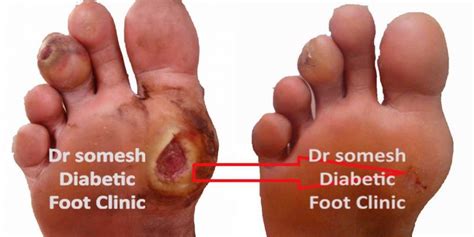 Diabetes Foot Gangrene stages 1st Metatarsal head region - Podiatry Doctor