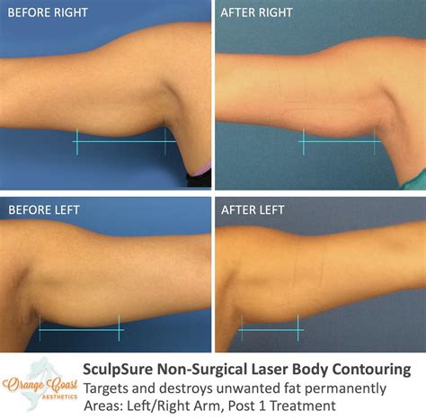 SculpSure Before and After Photos - Irvine, CA: Orange Coast Aesthetics