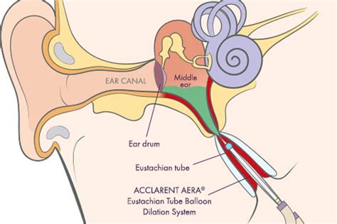 What Are The Common ETD Signs and Symptoms | J&J MedTech