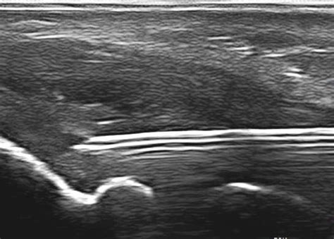 Percutaneous Needle Tenotomy — Avant Sports Medicine