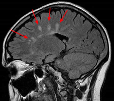 Brain lesions causes, brain lesions diagnosis and brain lesions treatment