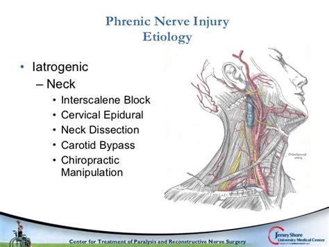 Comprehensive surgical management of the paralyzed diaphragm