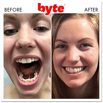 Byte Before & After Photos: Pics of Real Customer Results