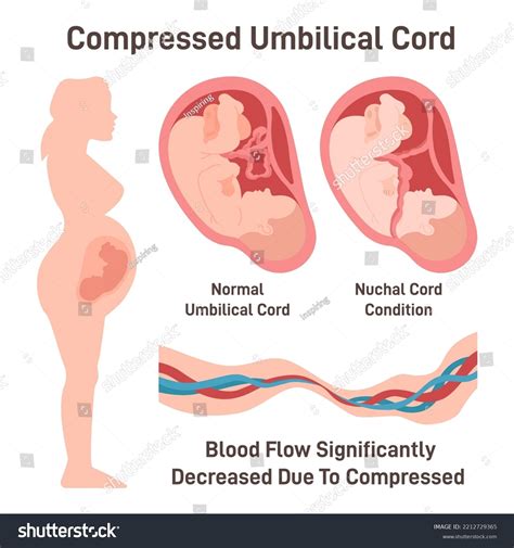 Compressed Umbilical Cord Obstruction Blood Flow Stock Vector (Royalty ...