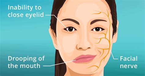 Bell's Palsy - Hohman Rehab and Sports Therapy