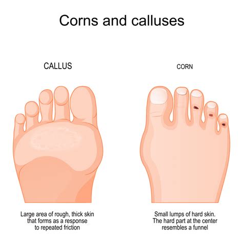 Corns & Calluses | Nova Family Podiatry