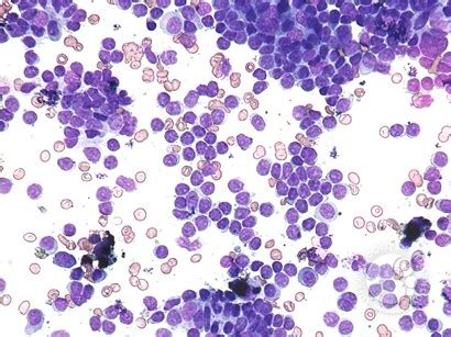 Hemophagocytosis on bone marrow aspirate and biopsy