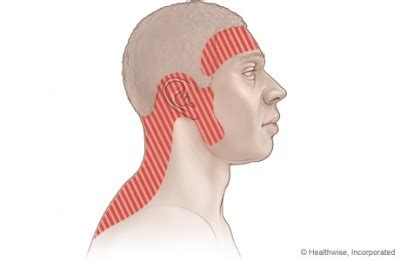 Tension-type headache - Physiopedia