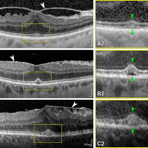 Sample cases from group II. Case 1: (a) baseline OCT scan of DME with... | Download Scientific ...