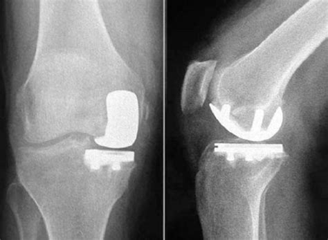 Uni knee is a good option to maintain function - Dr. Bu Balalla