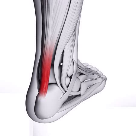 Achilles Tendon — Foot and Ankle Specialists