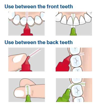 Interproximal Brush | The Dental Arcade – Blog