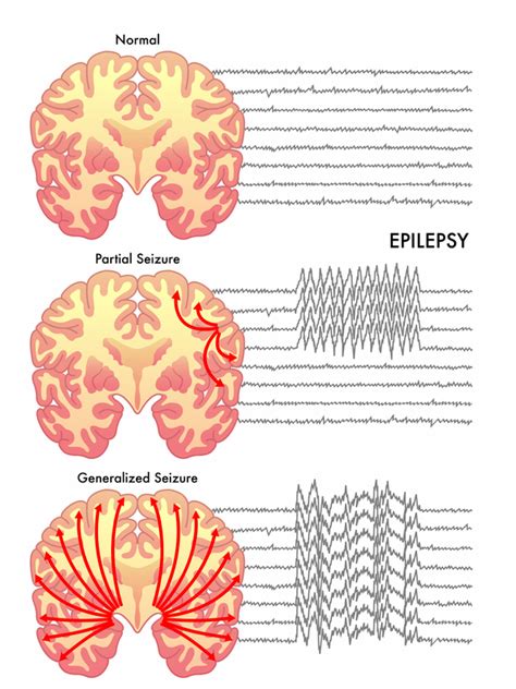 Seizure